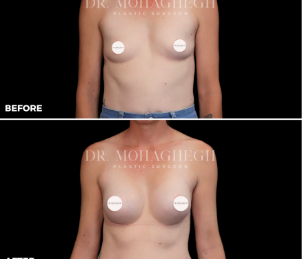 breast-treatment