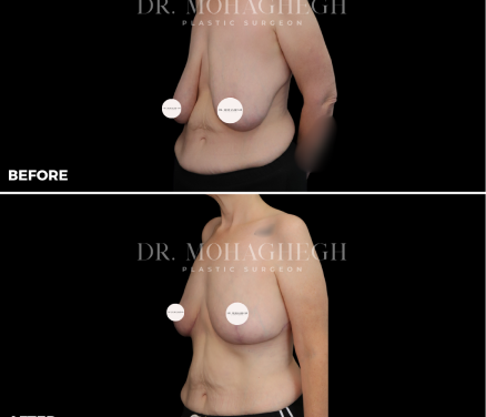 breast-treatment