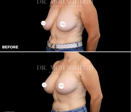 breast-treatment