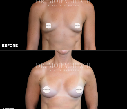breast-treatment