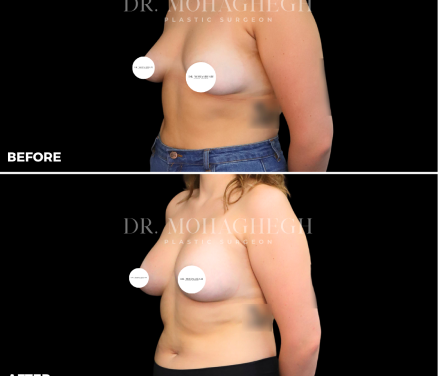 breast-treatment