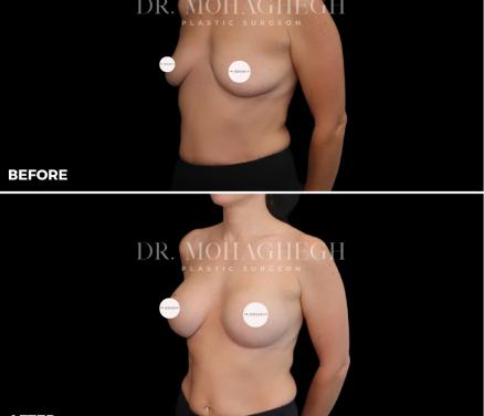 breast-treatment