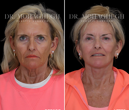 face-lift-treatment