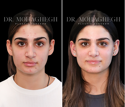 face-lift-treatment